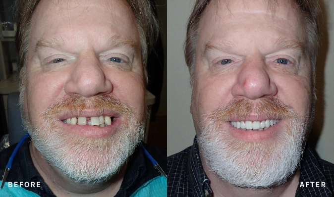 patient's before and after photos of dental services done at Beavercreek Dental
