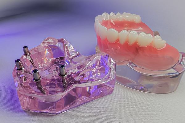 The Longevity Of Implant Supported Dentures